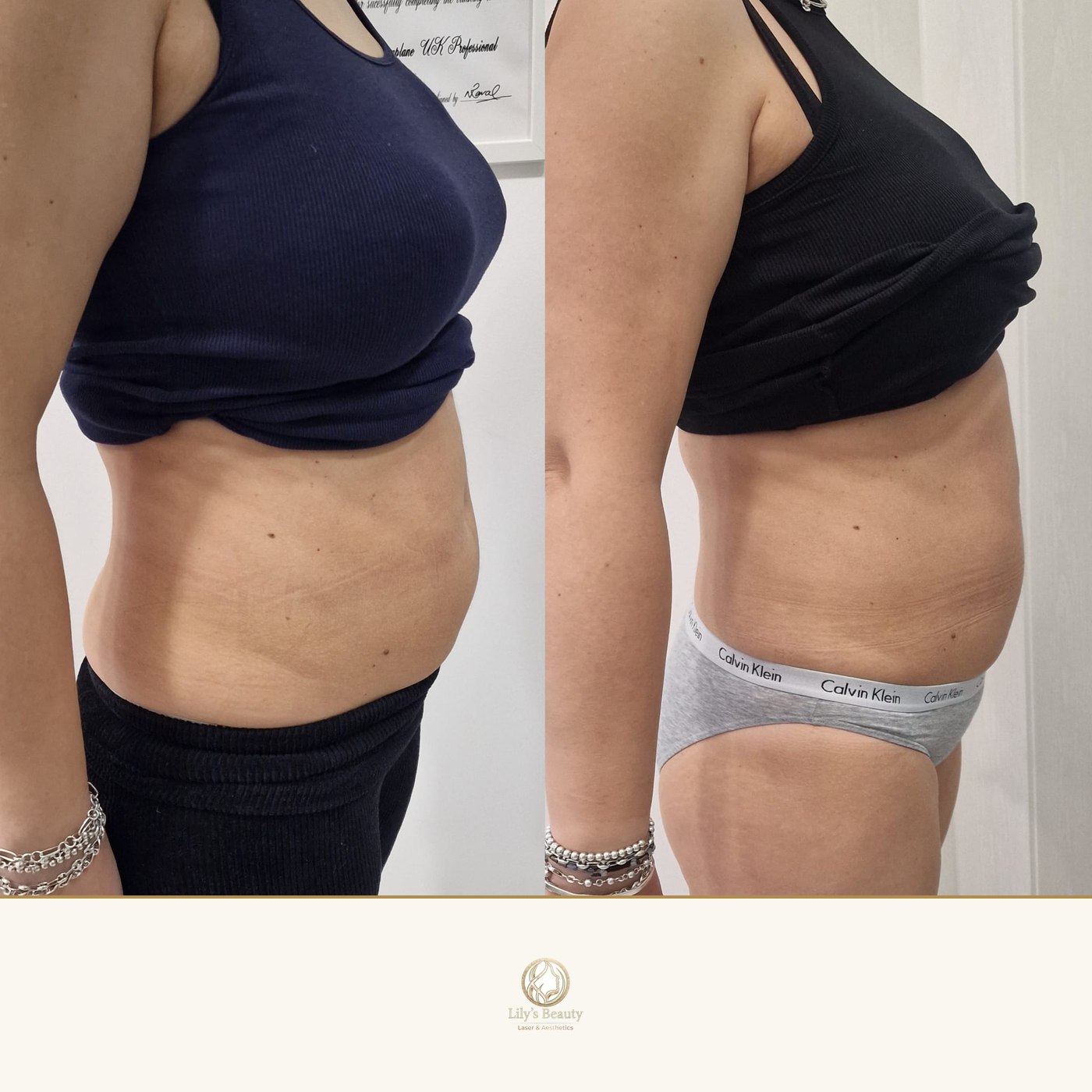 Cavitation before and after — real client result at Lily's Beauty