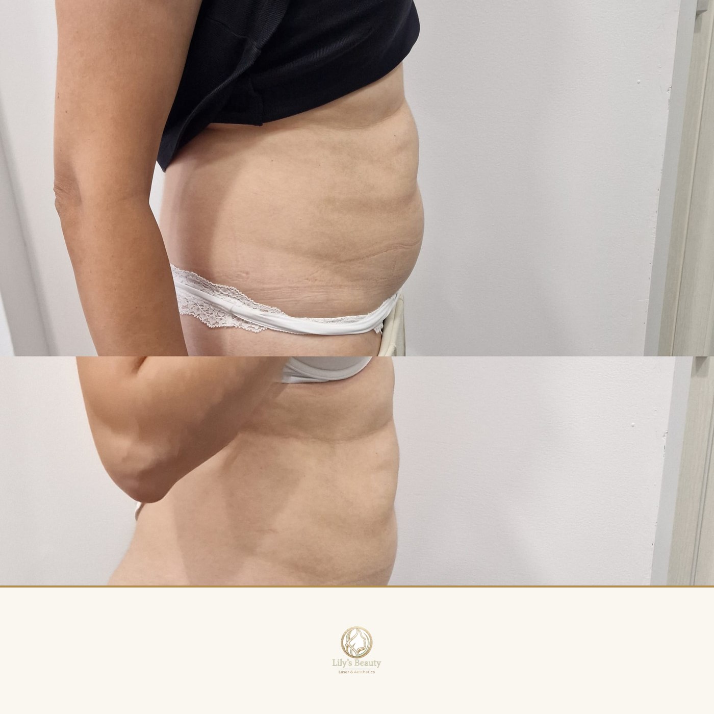 Fat Freezing before and after — real client result at Lily's Beauty