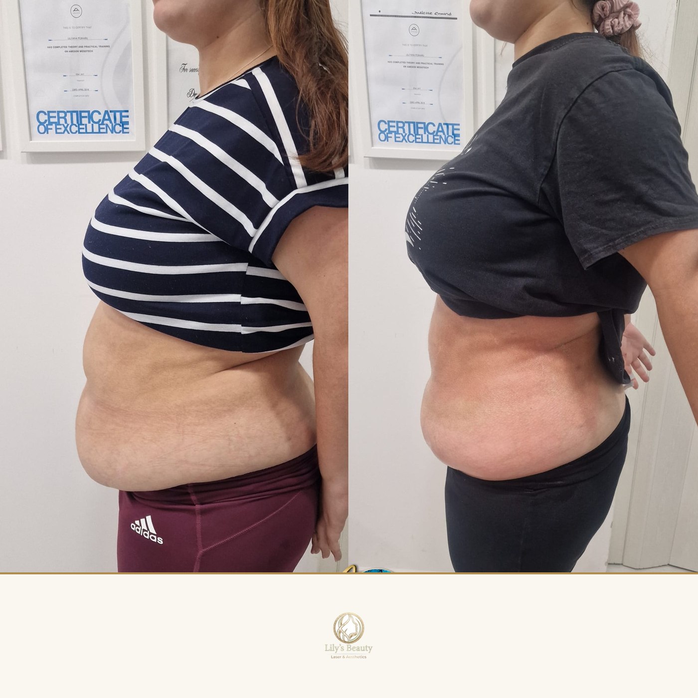 Fat Freezing before and after — real client result at Lily's Beauty