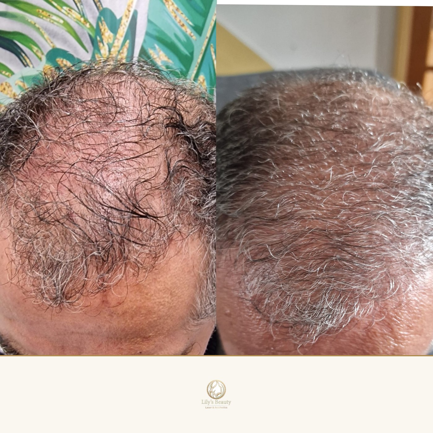 Hair Loss before and after — real client result at Lily's Beauty