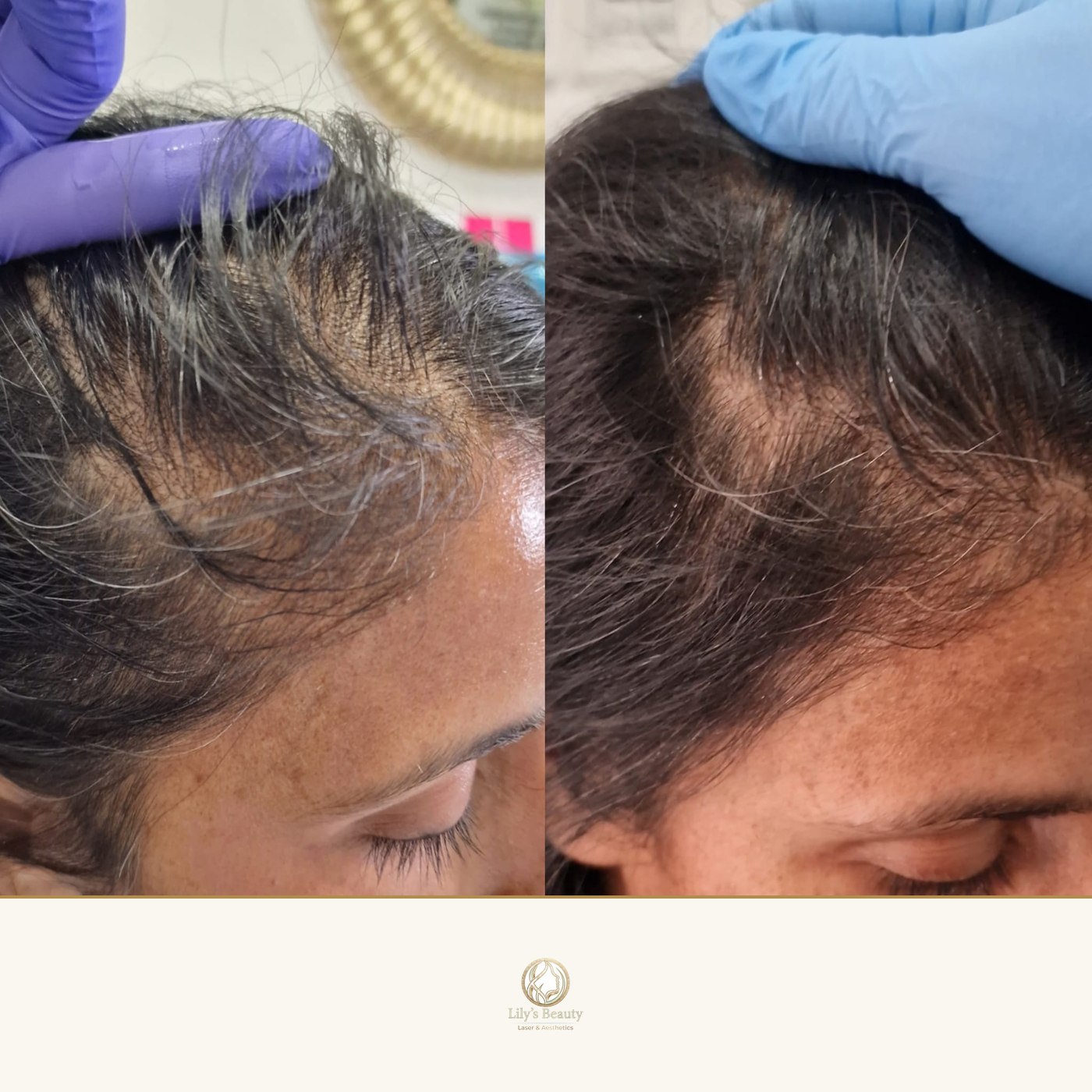 Hair Loss before and after — real client result at Lily's Beauty