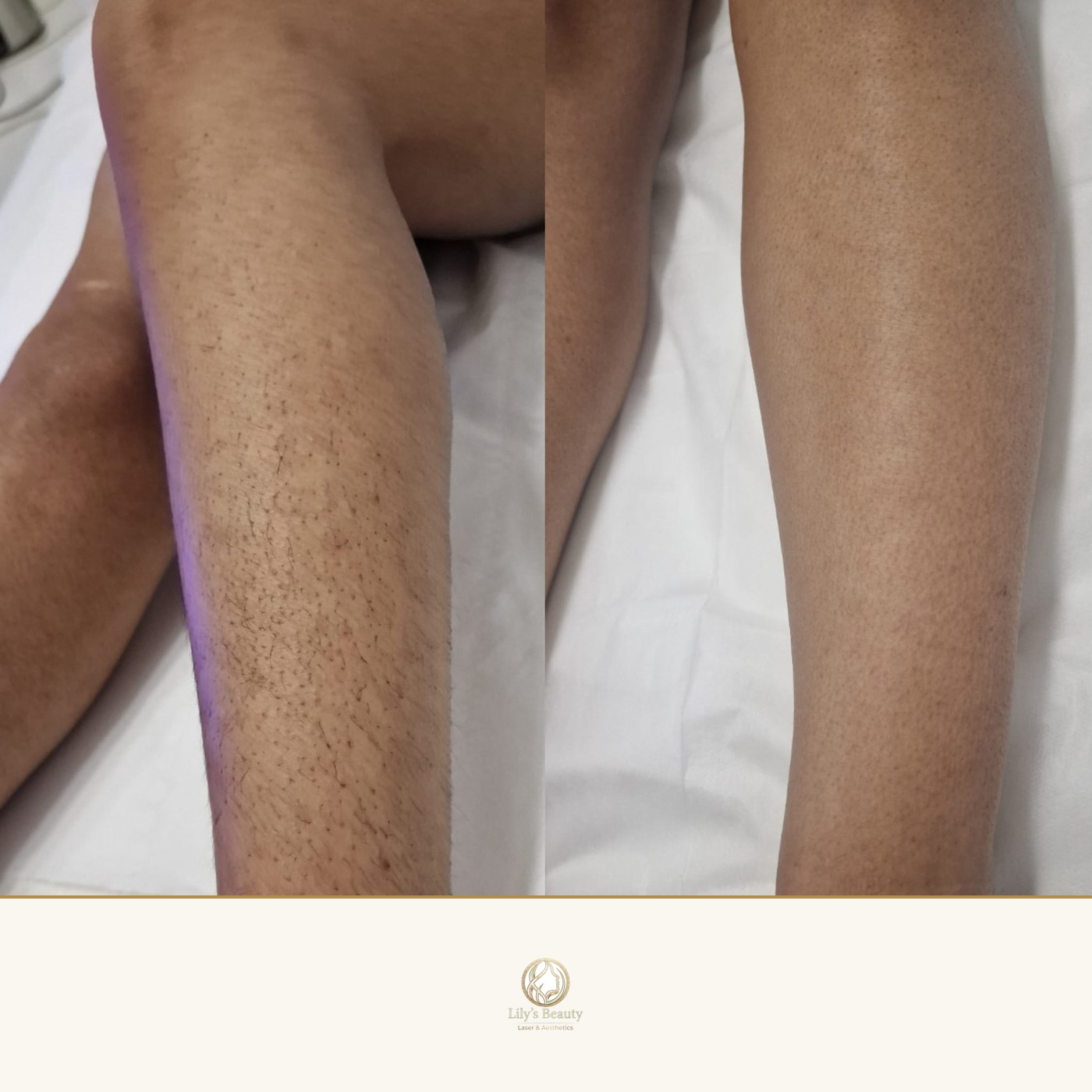 Laser Hair Removal before and after — real client result at Lily's Beauty