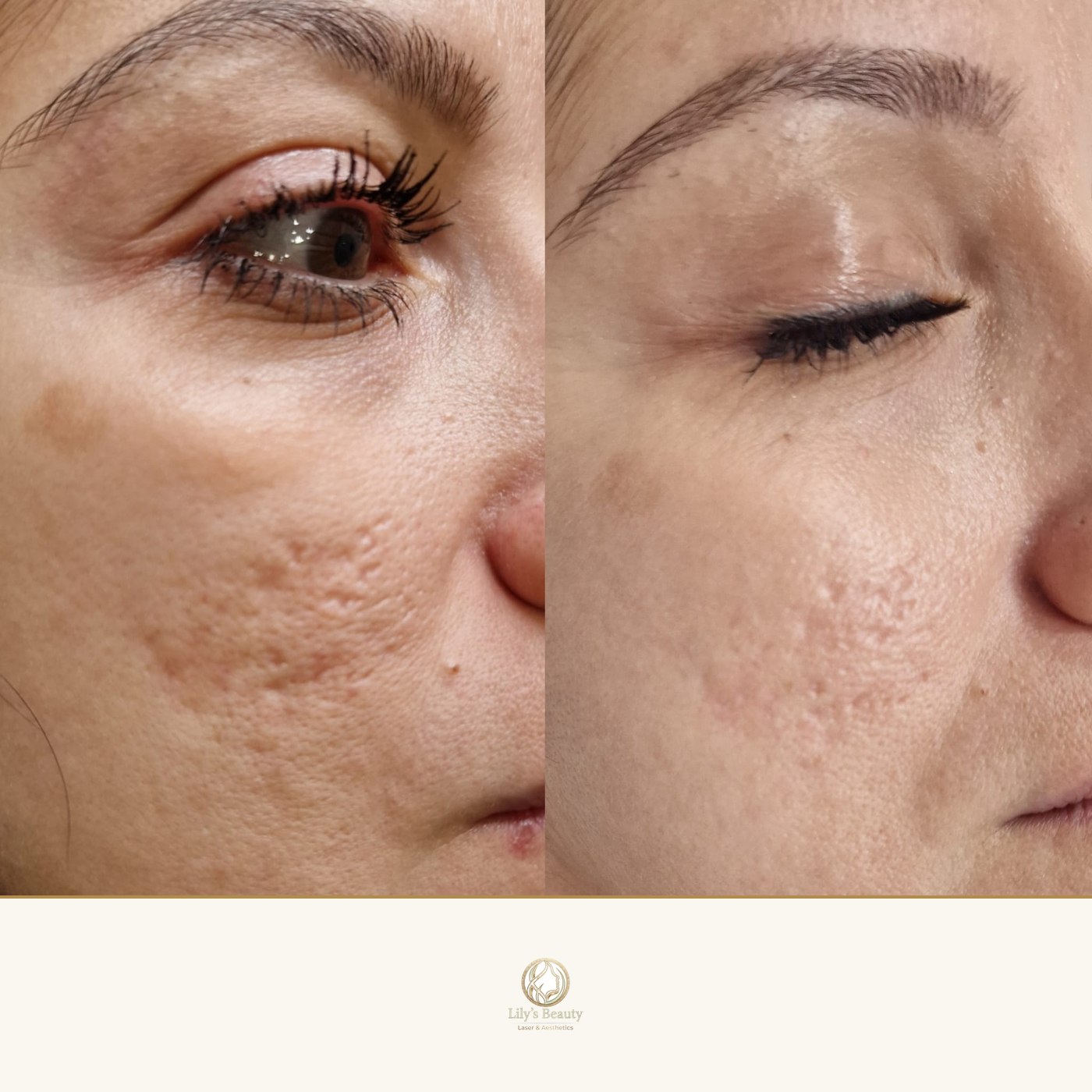 Microneedling before and after — real client result at Lily's Beauty