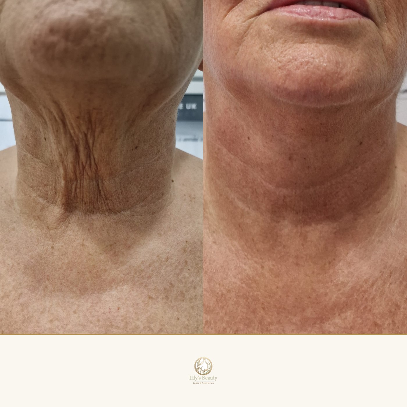 Skin Tightening before and after — real client result at Lily's Beauty